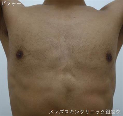 乳毛 男性|乳輪周りの脱毛[メンズ編]